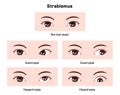 Types of strabismus vector illustration Royalty Free Stock Photo