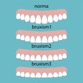 Types of teeth erasability. Layout attrition Bruxism teeth illustration vector. Erased teeth. Dental concept