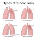 Types of Tuberculosis Royalty Free Stock Photo