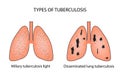 Types of tuberculosis. Miliary and disseminated pulmonary tuberculosis. Vector illustration on background