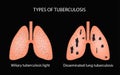 Types of tuberculosis. Miliary and disseminated pulmonary tuberculosis. Vector illustration on a black background