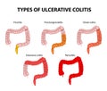 Types of Ulcerative Colitis Royalty Free Stock Photo