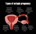 Types of uterine fibroids. Endometriosis. Infographics. Royalty Free Stock Photo