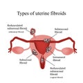 Types of uterine fibroids. Endometriosis. Infographics. Vector illustration isolated on white background Royalty Free Stock Photo