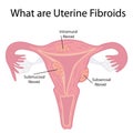 Types of Uterine Fibroids Royalty Free Stock Photo