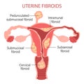 Types of uterine fibroids in women. Fibroids. Diseases of the female reproductive system. Gynecology. Medical concept. Royalty Free Stock Photo