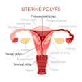 Types of uterine polyps. Diseases of the female reproductive system. Gynecology. Medical concept. Infographic banner.