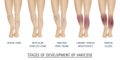 Types of varicose veins in women. Royalty Free Stock Photo