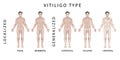 Types of Vitiligo. Medical illustration