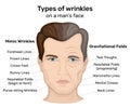 Types of wrinkles on a man`s face