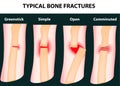 Typical bone fractures Royalty Free Stock Photo