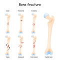 Typical bone fractures. Healthy femur and leg fracture in different stages