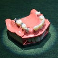 Typodont, the plastic moulage of human jaws and teeth, demonstrating tooth decay and metal fillings put in Royalty Free Stock Photo