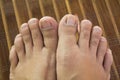 Ugly feet