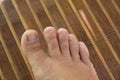 Ugly foot