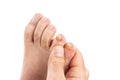 Ugly male toenails because of candida and fungal problems