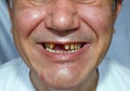 Ugly man with peeled teeth scratched face Royalty Free Stock Photo