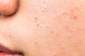 Ugly pimples, acne, zit and blackheads on the cheek of a teenager Royalty Free Stock Photo