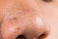 Ugly pimples, acne, zit and blackheads on the nose of a teenager