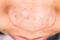 Ugly pimples, acne, zit and blackheads on the nose of a teenager