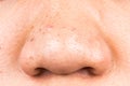 Ugly pimples, acne, zit and blackheads on the nose of a teenager Royalty Free Stock Photo