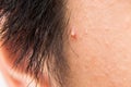 Ugly pimples, acne, zit and blackheads on the temple of a teenager