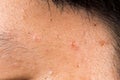 Ugly pimples, acne, zit and blackheads on the temple of a teenager