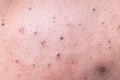 Ugly pimples blackheads on face of teenager