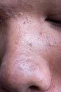 Ugly pimples blackheads on nose of teenager Royalty Free Stock Photo