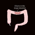 Ulcer in the intestine. Ulcers in the colon. Vector illustration on a black background