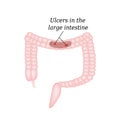 Ulcer in the intestine. Ulcers in the colon