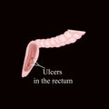 An ulcer in the rectum. Ulcers in the intestines. Vector illustration on a black background