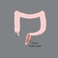 An ulcer in the rectum. Ulcers in the intestines