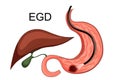 Ulcer of the stomach. EGD