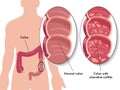 Ulcerative colitis