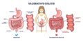 Ulcerative colitis as chronic inflammatory bowel disease outline diagram Royalty Free Stock Photo