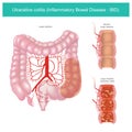 Ulcerative colitis. Illustration graphic.