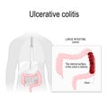 Ulcerative colitis