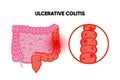 Ulcerative Colitis. Inflammatory bowel disease. Ulcer and inflammation of the digestive tract, abdominal pain. Human