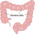 Ulcerative colitis intestine disease Royalty Free Stock Photo