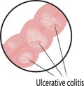 Ulcerative colitis intestine disease