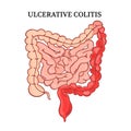 ULCERATIVE COLITIS Intestines Medicine Anatomy Vector Scheme Royalty Free Stock Photo