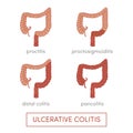 Ulcerative colitis Royalty Free Stock Photo