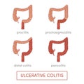 Ulcerative colitis