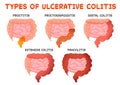 Ulcerative colitis types, gut disease, intestine inflammation from proctitis to pancolitis. Medical vector illustration