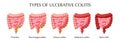 Ulcerative Colitis Types Infographics
