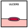 Ulcers hand drawn vector illustration in cartoon doodle style