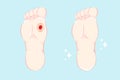 Ulcers on the foot