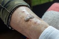 Ulcers and skin diseases, dried scabs and fresh wounds on the legs of an elderly woman, Health concept, senile changes