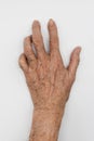 Ulnar claw hand of Asian elder man. also known as `spinster`s claw